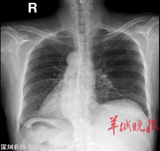 佛山一女子竟是 鏡面人  屬全內(nèi)臟反位