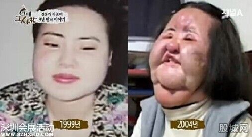 電風(fēng)扇大媽臉部腫脹恐怖至極 竟是整容惹的禍