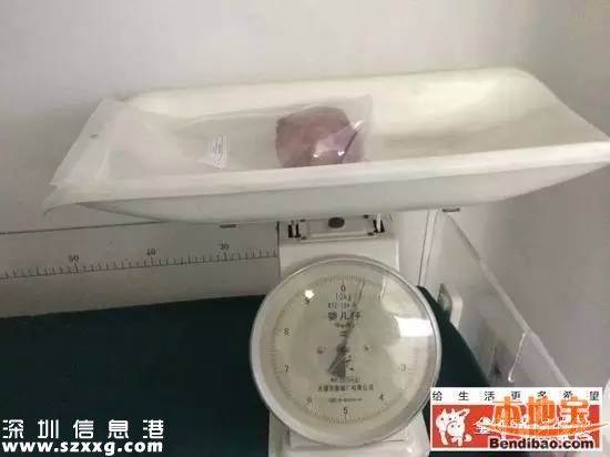 膀胱取出巨大結(jié)石 一斤重占滿整個(gè)膀胱
