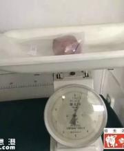 深圳一男子膀胱取出巨大結(jié)石 一斤重占滿整個膀胱
