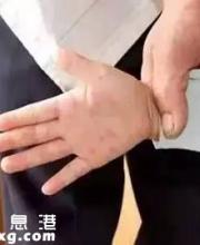 深圳手足口病高發(fā)期 家長應(yīng)該怎么做呢？