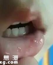 手足口病的主要癥狀