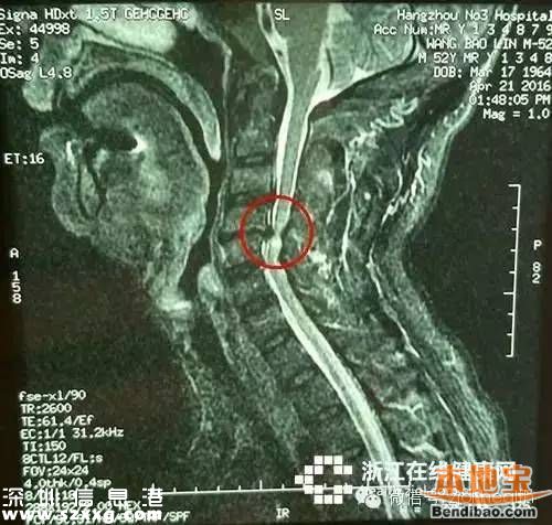 喝可樂(lè)致四肢癱瘓 到底是什么惹的禍？