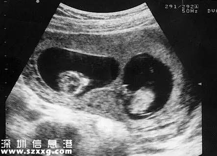 深圳懷雙胞胎做B超交雙倍錢(qián) 收費(fèi)合理嗎？