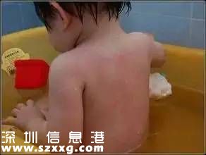 深圳發(fā)現(xiàn)今年首例猩紅熱病例 有小孩的注意啦！