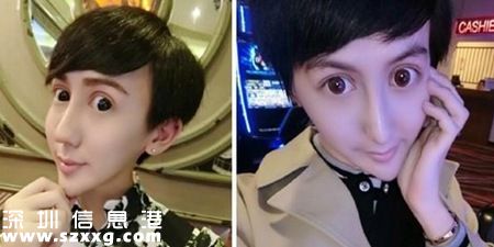蛇精男1天打14針玻尿酸