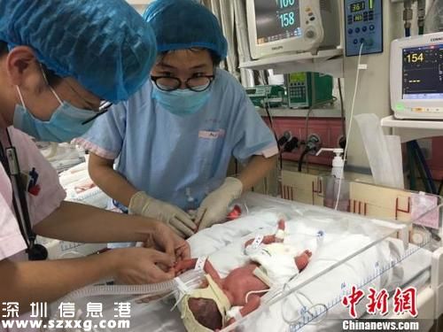 罕見同卵四胞胎上海降生