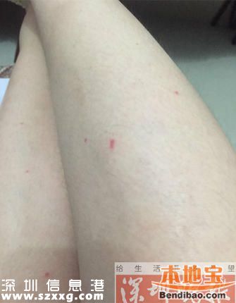 女子深圳住酒店半夜床上驚現(xiàn)十幾只蟲(chóng) 身上又癢又痛