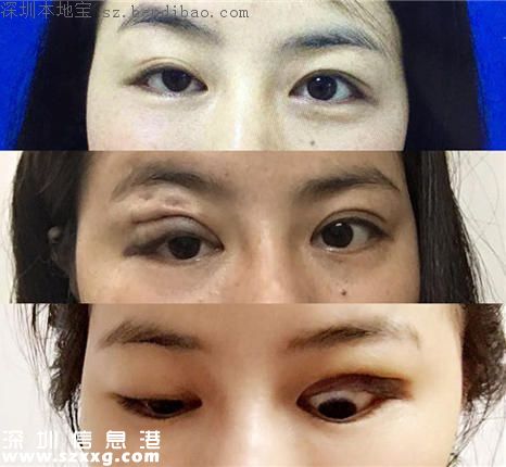 深圳女子2.6萬做眼部整容變毀容 醫(yī)院:會慢慢恢復(fù)