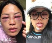 節(jié)目被暴打 只見臉上紅腫嚇人險些被毀容